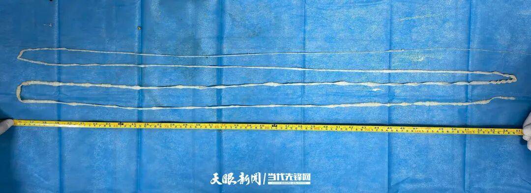 土耳其甲组联赛_最长4米!贵州一男子连续7个月排出“面条状异物”土耳其甲组联赛,医生:很可能和吃这种生食有关