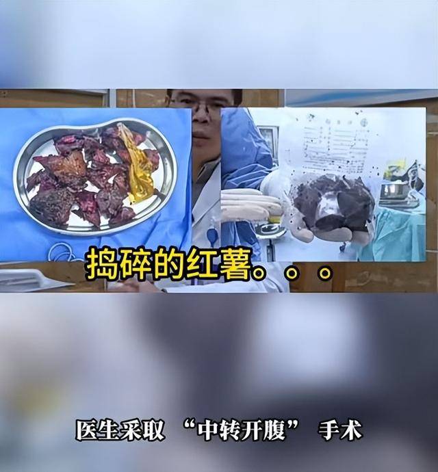 皇冠平台_61岁男子将17cm红薯塞入肛门皇冠平台，半夜疼痛难忍被迫就医，医生：尺寸过大，得开腹