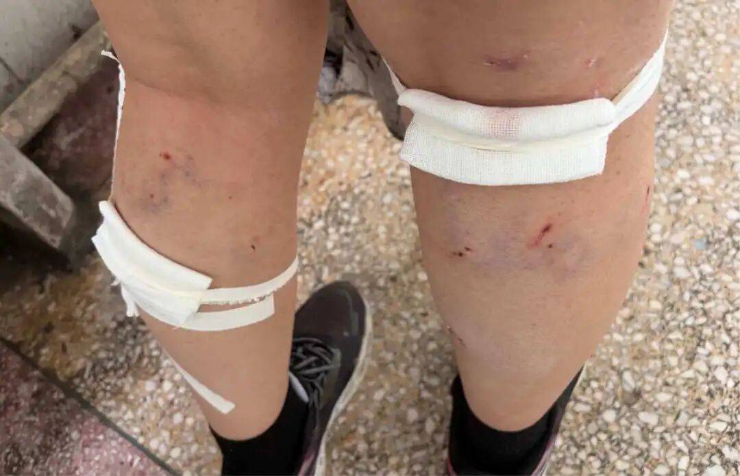 皇冠信用网会员账号_河南一女大学生遭校园内群狗围攻咬伤皇冠信用网会员账号，幸亏有同学骑电动车撞开狗群而获救，流浪狗至今仍在校园，校方称将联系保卫处处理